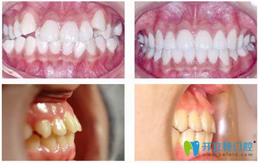 南京雅康口腔牙齒矯正案例