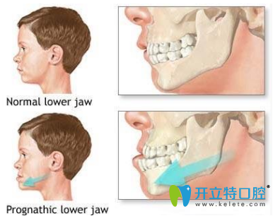 牙齒畸形給學(xué)生帶來五大危害