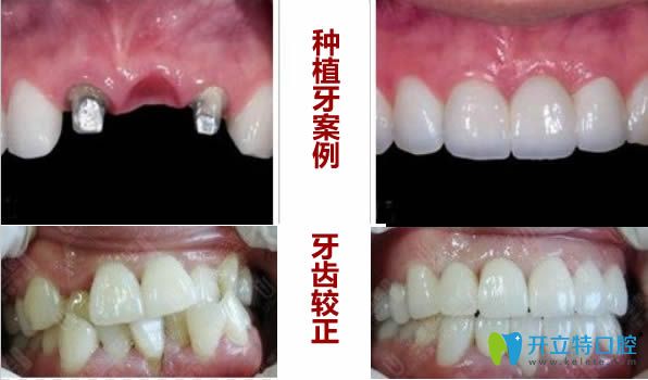 邯鄲貝潔口腔種植牙和牙齒矯正案例效果圖