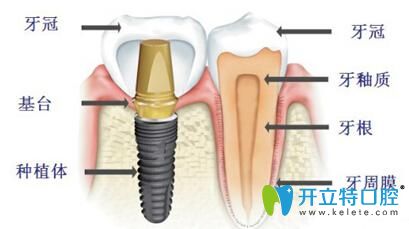 關(guān)于種植牙 你想了解的柳州牙衛(wèi)士口腔都能告訴你