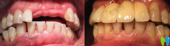 廈門登特口腔盧偉醫(yī)生種植牙案例效果圖