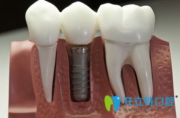 維樂口腔醫(yī)生告訴你：無痛種植牙有什么優(yōu)勢?