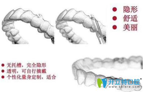 隱形矯正的優(yōu)勢