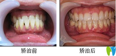 拜博拜爾口腔楊國平醫(yī)生隱形矯正牙齒效果圖