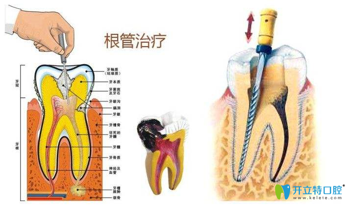 根管治療解析圖