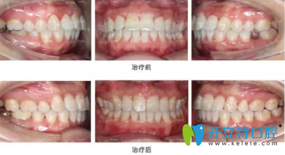 完全恢復(fù)之后我簡直很開心，牙齒就這么完美了