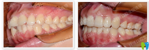 佛山拜博口腔牙齒矯正案例對(duì)比圖
