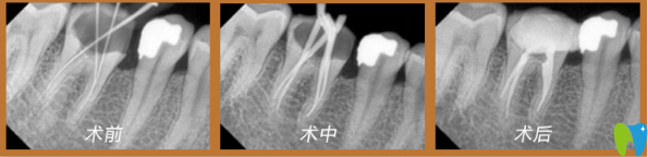 牙齒蛀蟲(chóng)治療過(guò)程