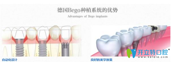 榆林長(zhǎng)虹口德國(guó)種植牙系統(tǒng)優(yōu)勢(shì)