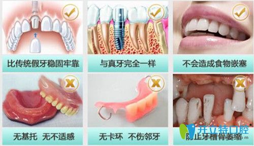 丁麗香口腔門診部即刻種植牙技術(shù)