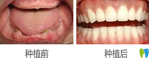 蒙恩齒科黃美華全口牙種植前后效果對比圖