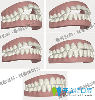 蒙恩齒科程碧煥為我做的隱適美牙齒矯正3D效果圖