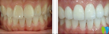 蒙恩齒科冷光牙齒美白前后效果對(duì)比圖