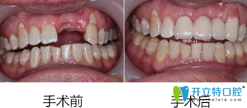 深圳蒙恩齒科黃美華單顆種植牙前后效果對比圖