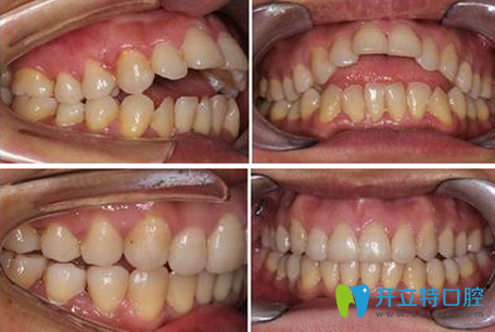 蒙恩齒科隱形牙齒矯正前后效果對(duì)比圖