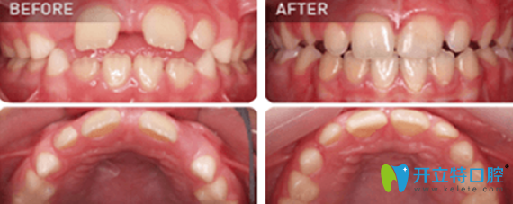 16歲孩子在東莞拜博口腔做MRC正牙寶牙齒矯正案例對比圖