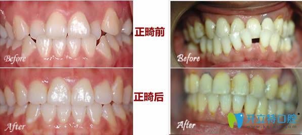26歲輕微牙齒不齊矯正和28歲反頜且牙齒間隙正畸前后對比照