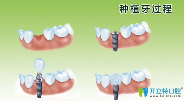 種植牙分幾個步驟