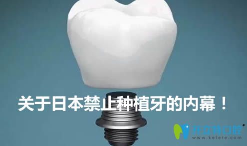 內(nèi)幕！日本為什么停止種植牙？禁止種植牙是真的嗎？