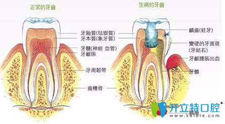 拔牙神經(jīng)疼嗎疼多長(zhǎng)時(shí)間？一般拔牙神經(jīng)要多少錢(qián)