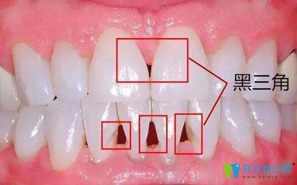 矯正牙齒導(dǎo)致的黑三角