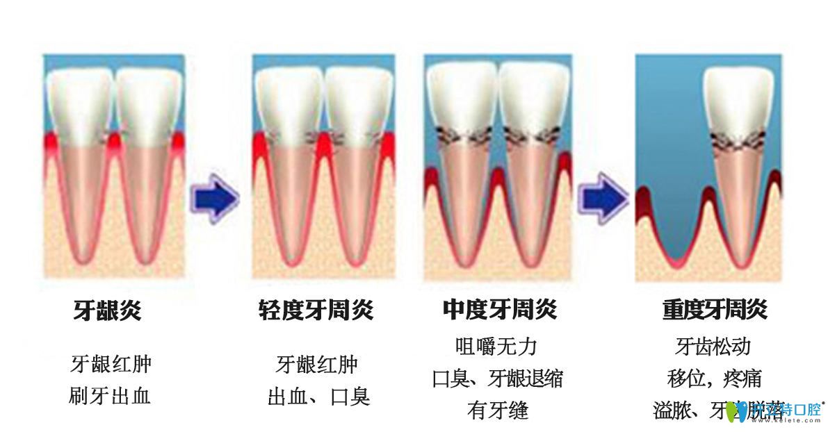 導(dǎo)致牙齒黑三角的6大原因