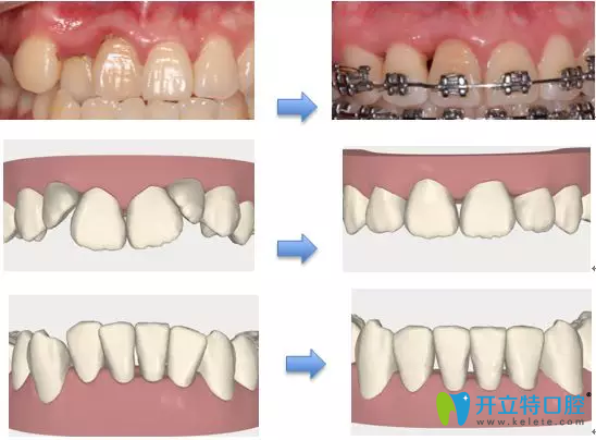 牙齒矯正導(dǎo)致黑三角的原理圖