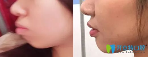 牙齒矯正會不會改變臉型