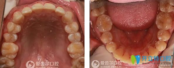 自鎖托槽矯正牙齒一年后