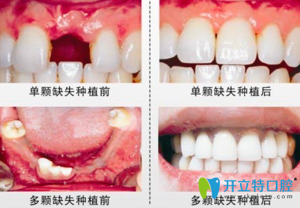 杭州科瓦齒科種植牙前后效果對(duì)比圖