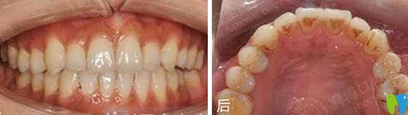 天津拜博口腔隱形矯正18個(gè)月后效果
