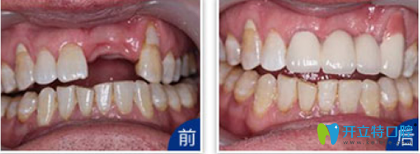 天津拜博口腔門牙缺失種植效果