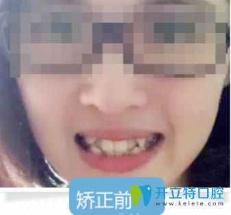 誰說26歲就沒必要矯正牙齒了?來看深圳拜爾成年人正畸案例