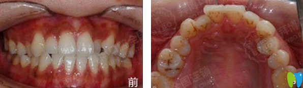 天津拜博口腔隱形矯正牙齒前