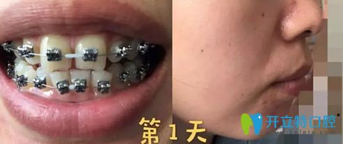 熊洪元做牙齒矯正第1天樣子