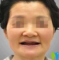 牙友稱在寧波牙博士口腔做即刻種植牙價格實(shí)惠 