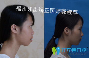 牙醫(yī)郭淑蘋時(shí)代天使隱形矯正案例對比效果