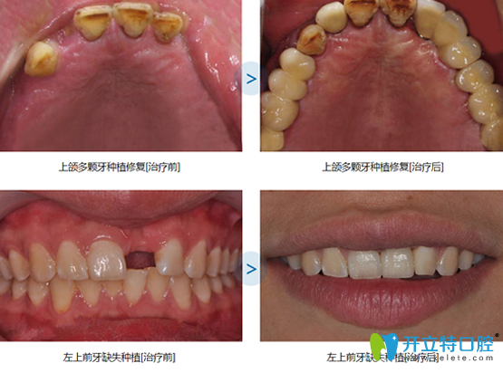 多顆牙缺失種植+單顆門牙缺失種植案例