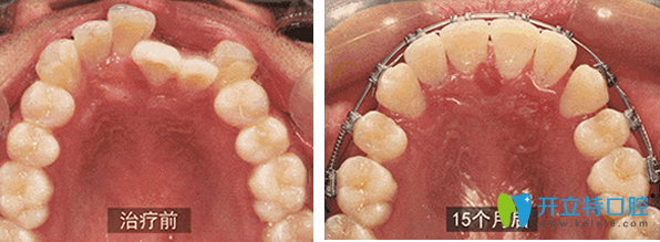 壹加壹牙科矯正牙齒效果