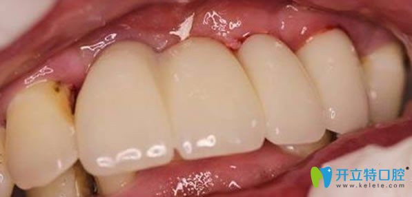 佳士潔口腔多顆牙缺失微創(chuàng)無痛種植牙術后效果圖