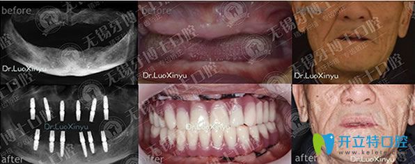 牙博士口腔樸東信院長全口種植牙代表案例