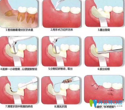 阻生智齒拔出過(guò)程圖