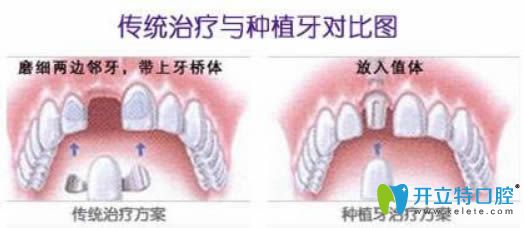 種植牙和鑲牙步驟圖示