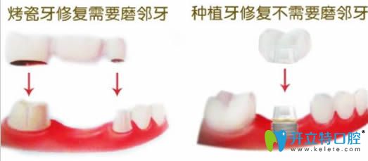 種植牙和鑲牙的區(qū)別在于前者需要磨牙后者不磨牙