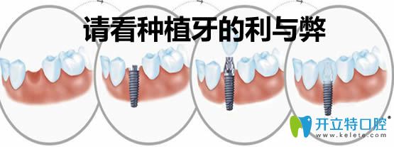 薛國初醫(yī)生解析牙齒種植的利與弊