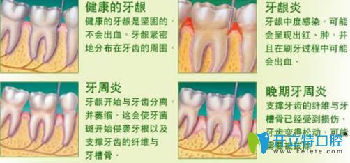 開立特有關(guān)牙周炎的詳解圖