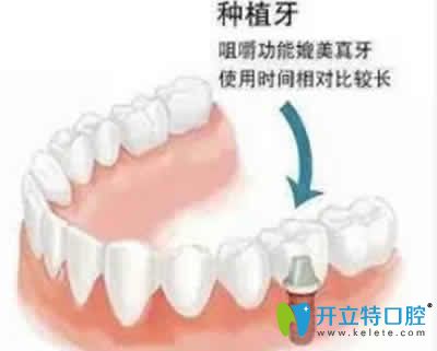 新疆凱樂口腔解惑 為什么單顆種植牙價格趕上奢侈品LV價格