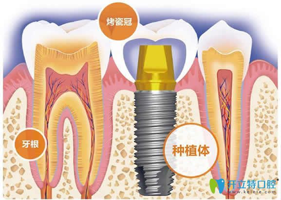 牙友們別問(wèn)種植牙的價(jià)格了，先來(lái)看自己適合種牙嗎