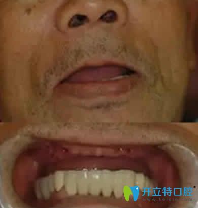 6旬老人講述在寧波現(xiàn)代口腔做ALL-on-4半口牙種植牙親身經(jīng)歷