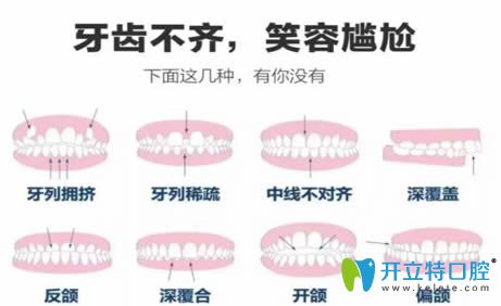 26歲在深圳美萊口腔戴隱適美隱形牙套矯正齙牙經(jīng)歷是這樣的